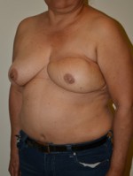 Breast Reconstruction