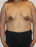 Breast Reconstruction