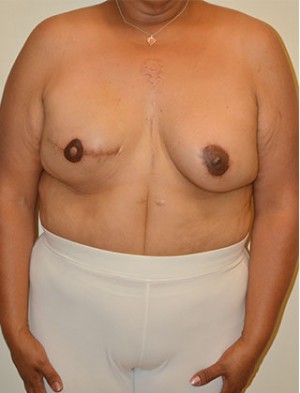 Breast Reconstruction Case 4233 After Photo Breast Reconstruction