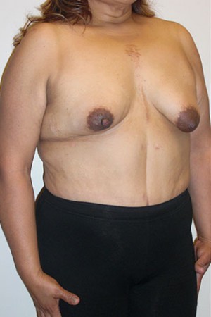 Breast Reconstruction Case 4233 Before Photo Breast Reconstruction