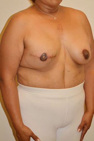 Breast Reconstruction Case 4233 After Photo Breast Reconstruction