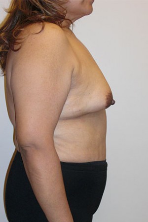Breast Reconstruction Case 4233 Before Photo Breast Reconstruction