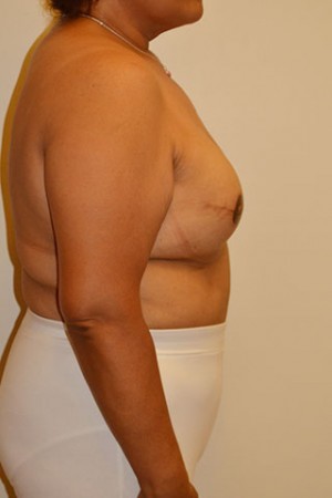 Breast Reconstruction Case 4233 After Photo Breast Reconstruction
