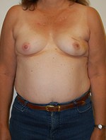Breast Reconstruction