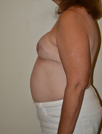 Breast Reconstruction Case 4241 After Photo Breast Reconstruction
