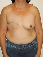 Breast Reconstruction