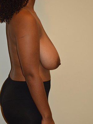 Breast Reduction