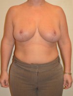 Breast Reduction