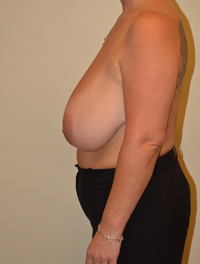 Breast Reduction Case 4287 Before Photo Breast Reduction