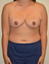 Breast Reduction Case 4295 After Photo Breast Reduction