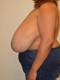 Breast Reduction Case 4303 Before Photo Breast Reduction