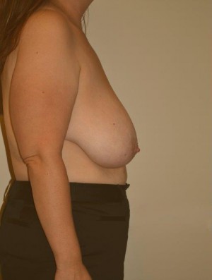 Breast Reduction Case 4319 Before Photo Breast Reduction