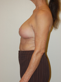 Breast Reduction Case 4327 After Photo Breast Reduction
