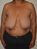 Breast Reduction