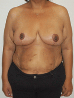 Breast Reduction