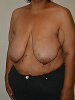 Breast Reduction