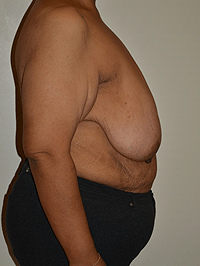 Breast Reduction Case 4335 Before Photo Breast Reduction