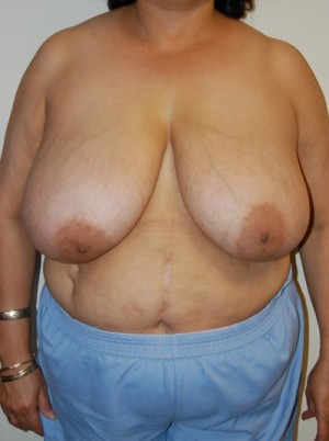 Breast Reduction Case 4359 Before Photo Breast Reduction