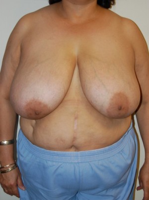 Breast Reduction