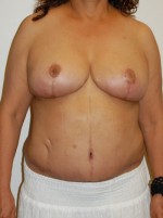 Breast Reduction