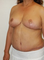Breast Reduction