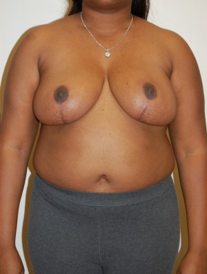 Breast Reduction Case 4367 After Photo Breast Reduction