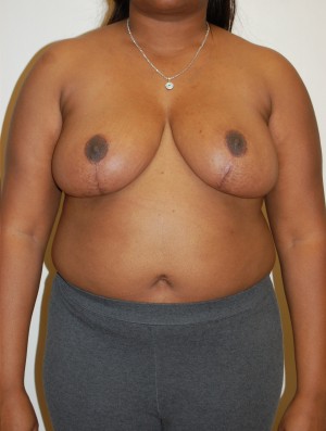 Breast Reduction