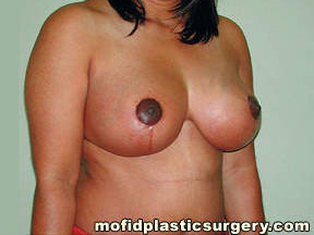 Breast Reduction Case 4383 After Photo Breast Reduction