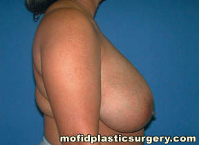 Breast Reduction Case 4383 Before Photo Breast Reduction