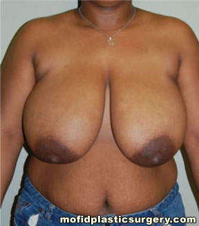 Breast Reduction Case 4391 Before Photo Breast Reduction