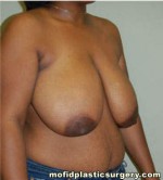 Breast Reduction