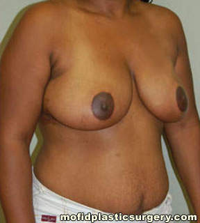Breast Reduction Case 4391 After Photo Breast Reduction