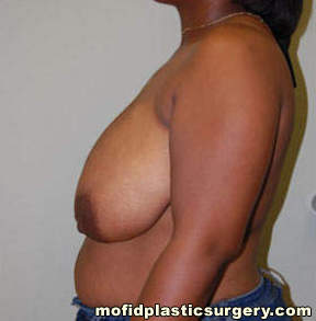 Breast Reduction Case 4391 Before Photo Breast Reduction