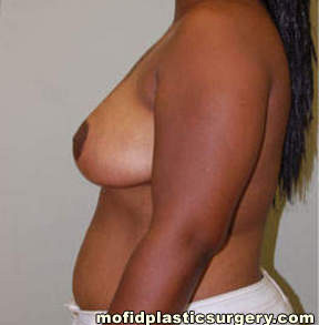 Breast Reduction Case 4391 After Photo Breast Reduction