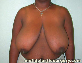 Breast Reduction Case 4399 Before Photo Breast Reduction
