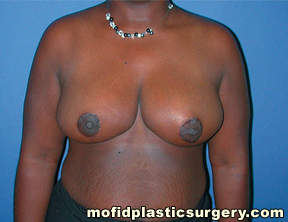 Breast Reduction Case 4399 After Photo Breast Reduction