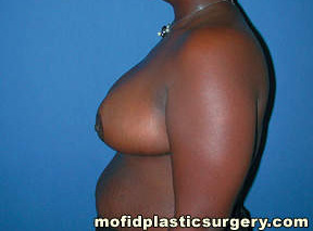 Breast Reduction Case 4399 After Photo Breast Reduction