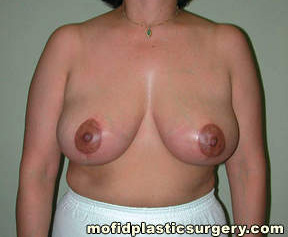 Breast Reduction Case 4407 After Photo Breast Reduction