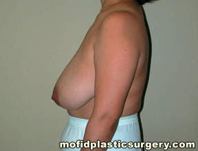 Breast Reduction Case 4407 Before Photo Breast Reduction