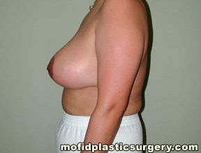 Breast Reduction Case 4407 After Photo Breast Reduction