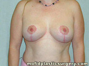 Breast Reduction Case 4441 After Photo Breast Reduction