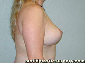 Breast Reduction Case 4441 After Photo Breast Reduction