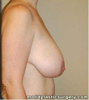Breast Reduction Case 4450 Before Photo Breast Reduction