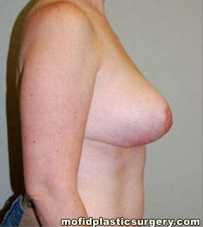 Breast Reduction Case 4450 After Photo Breast Reduction
