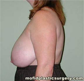 Breast Reduction Case 4458 Before Photo Breast Reduction
