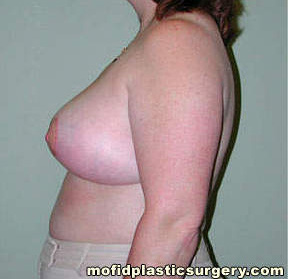 Breast Reduction Case 4458 After Photo Breast Reduction