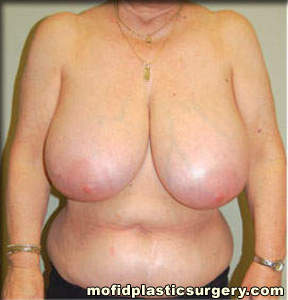 Breast Reduction Case 4466 Before Photo Breast Reduction