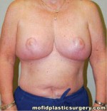 Breast Reduction