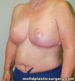 Breast Reduction