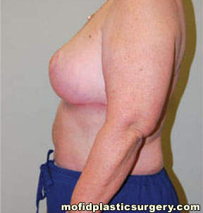 Breast Reduction Case 4466 After Photo Breast Reduction